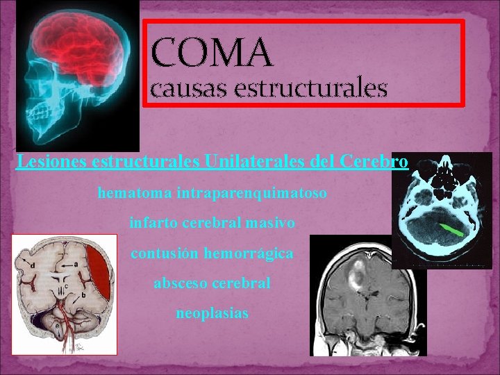 COMA causas estructurales Lesiones estructurales Unilaterales del Cerebro hematoma intraparenquimatoso infarto cerebral masivo contusión COMA causas estructurales Lesiones estructurales Unilaterales del Cerebro hematoma intraparenquimatoso infarto cerebral masivo contusión