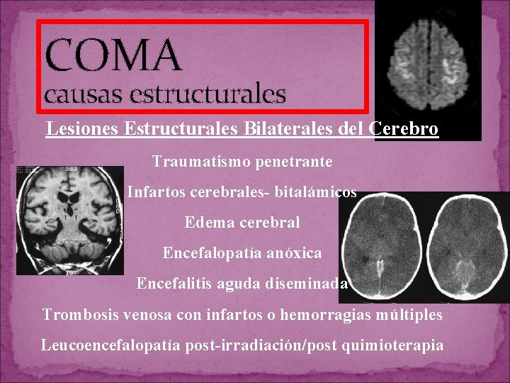 COMA causas estructurales Lesiones Estructurales Bilaterales del Cerebro Traumatismo penetrante Infartos cerebrales- bitalámicos Edema COMA causas estructurales Lesiones Estructurales Bilaterales del Cerebro Traumatismo penetrante Infartos cerebrales- bitalámicos Edema
