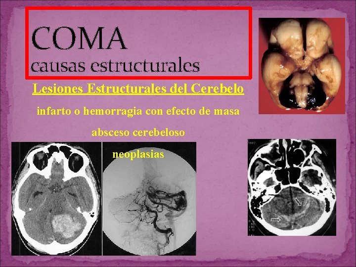 COMA causas estructurales Lesiones Estructurales del Cerebelo infarto o hemorragia con efecto de masa COMA causas estructurales Lesiones Estructurales del Cerebelo infarto o hemorragia con efecto de masa