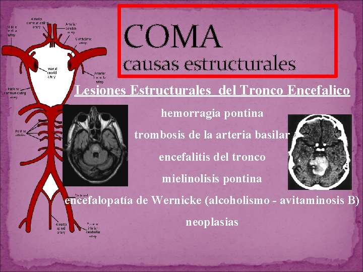 COMA causas estructurales Lesiones Estructurales del Tronco Encefalico hemorragia pontina trombosis de la arteria COMA causas estructurales Lesiones Estructurales del Tronco Encefalico hemorragia pontina trombosis de la arteria