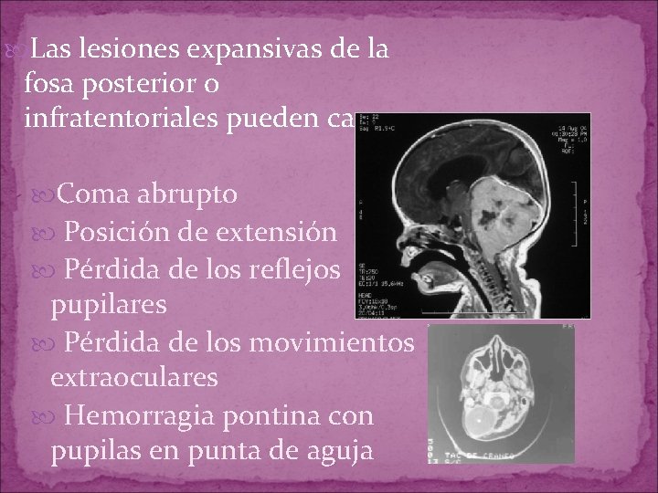 Las lesiones expansivas de la fosa posterior o infratentoriales pueden causar: Coma abrupto Las lesiones expansivas de la fosa posterior o infratentoriales pueden causar: Coma abrupto