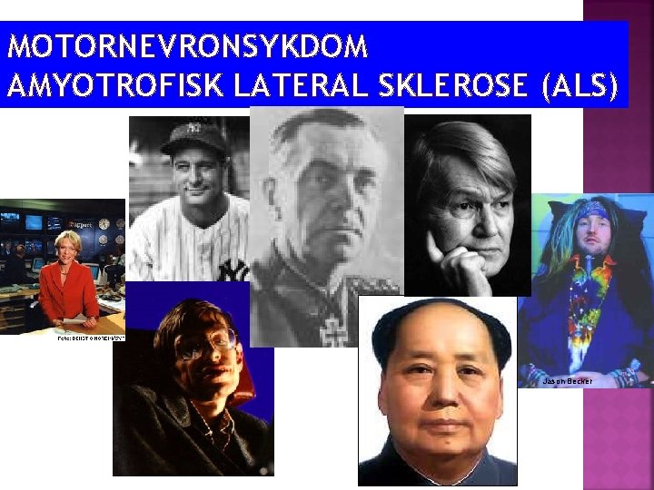 MOTORNEVRONSYKDOM AMYOTROFISK LATERAL SKLEROSE (ALS) Jason Becker 