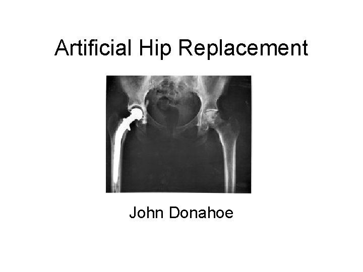 Artificial Hip Replacement John Donahoe 
