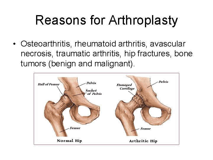 Reasons for Arthroplasty • Osteoarthritis, rheumatoid arthritis, avascular necrosis, traumatic arthritis, hip fractures, bone
