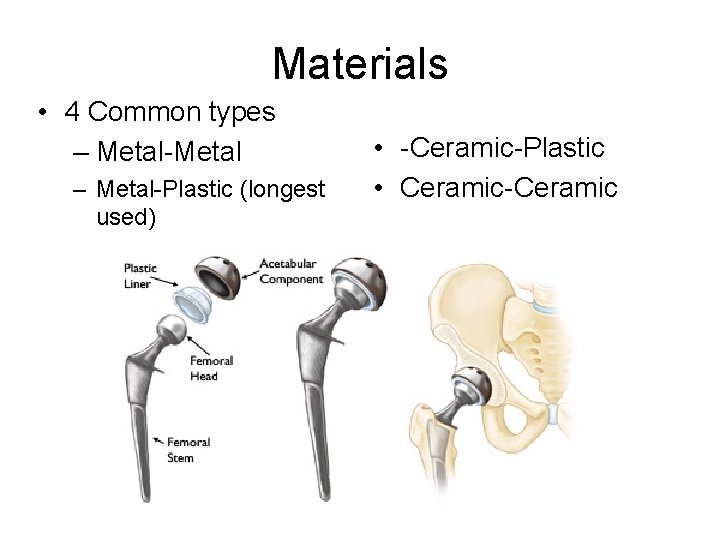 Materials • 4 Common types – Metal-Metal – Metal-Plastic (longest used) • -Ceramic-Plastic •