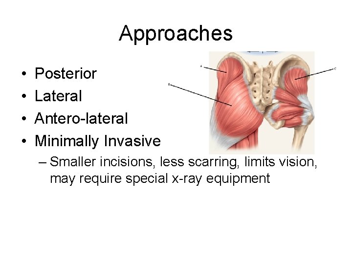 Approaches • • Posterior Lateral Antero-lateral Minimally Invasive – Smaller incisions, less scarring, limits