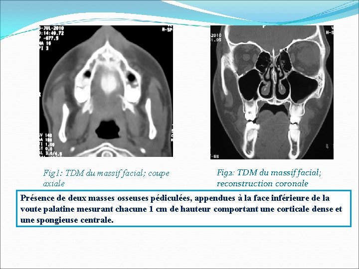 Fig 1: TDM du massif facial; coupe axiale Fig 2: TDM du massif facial;