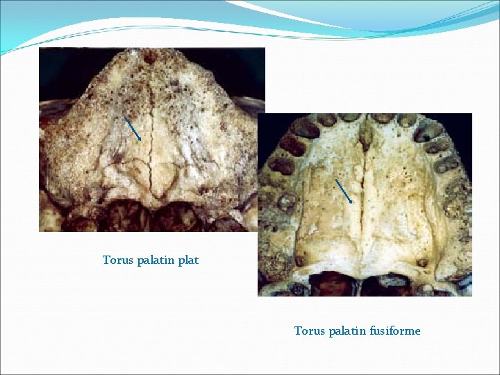 Torus palatin plat Torus palatin fusiforme 
