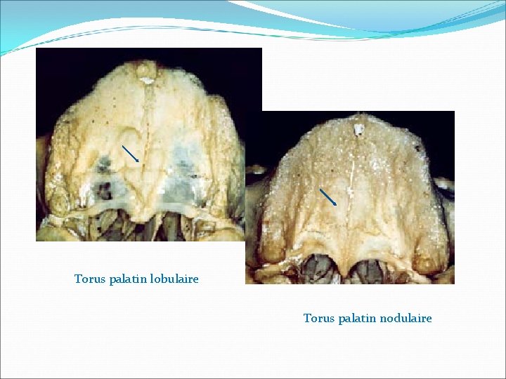 Torus palatin lobulaire Torus palatin nodulaire 