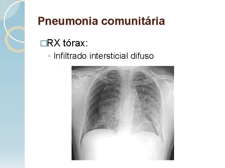 Pneumonia comunitária �RX tórax: ◦ Infiltrado intersticial difuso 