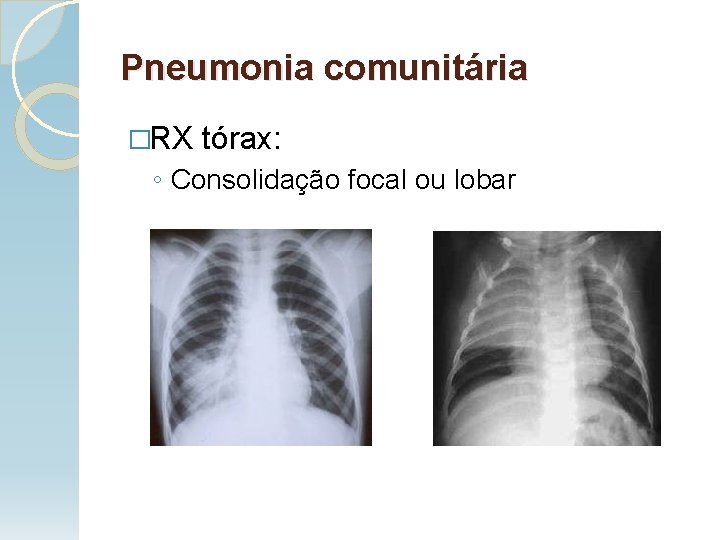 Pneumonia comunitária �RX tórax: ◦ Consolidação focal ou lobar 