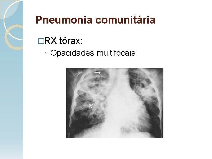 Pneumonia comunitária �RX tórax: ◦ Opacidades multifocais 