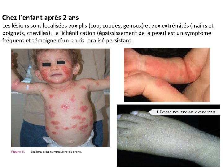 Chez l’enfant après 2 ans Les lésions sont localisées aux plis (cou, coudes, genoux)