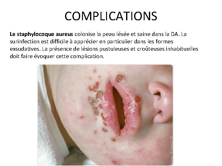 COMPLICATIONS Le staphylocoque aureus colonise la peau lésée et saine dans la DA. La