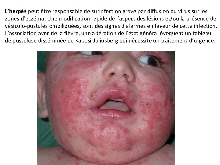 L’herpès peut être responsable de surinfection grave par diffusion du virus sur les zones