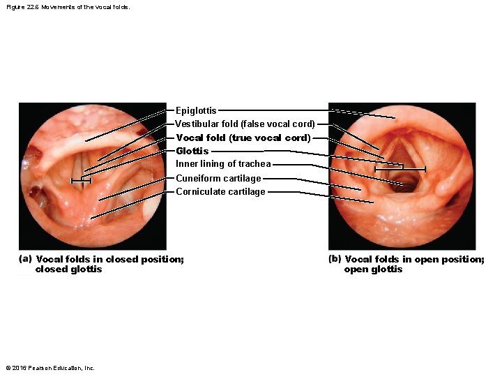 Figure 22. 6 Movements of the vocal folds. Epiglottis Vestibular fold (false vocal cord)