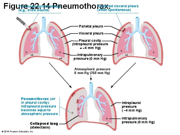 Ruptured visceral pleura Punctured parietal pleura Figure 22. 14 Pneumothorax. (often spontaneous) (e. g.