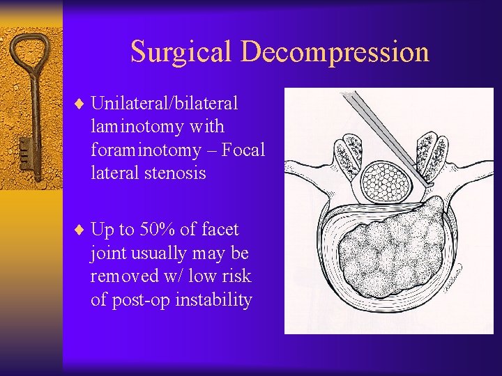 Surgical Decompression ¨ Unilateral/bilateral laminotomy with foraminotomy – Focal lateral stenosis ¨ Up to