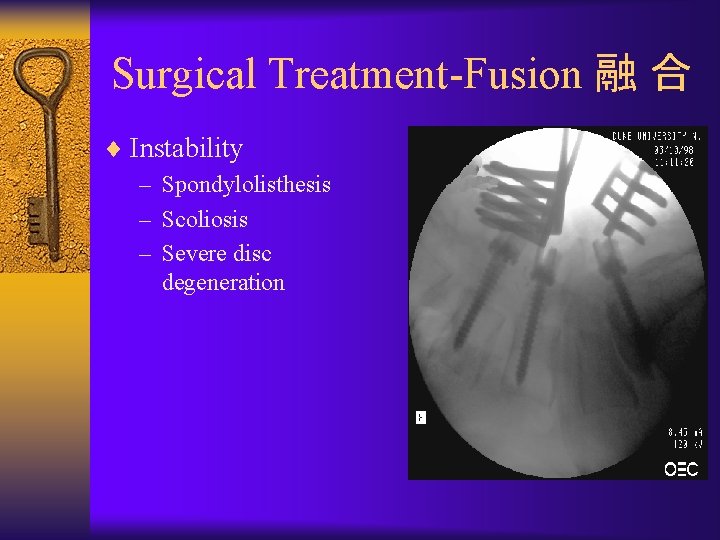 Surgical Treatment-Fusion 融 合 ¨ Instability – Spondylolisthesis – Scoliosis – Severe disc degeneration
