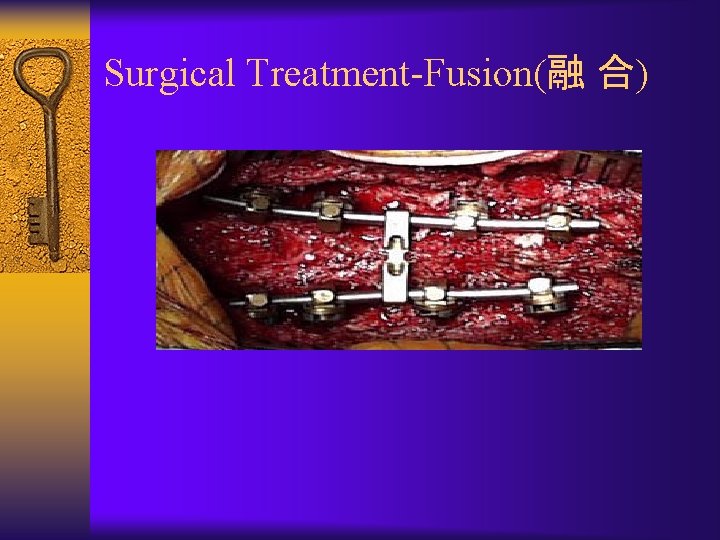 Surgical Treatment-Fusion(融 合) 