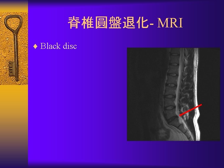 脊椎圓盤退化- MRI ¨ Black disc 