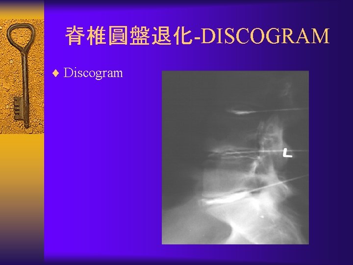 脊椎圓盤退化-DISCOGRAM ¨ Discogram 