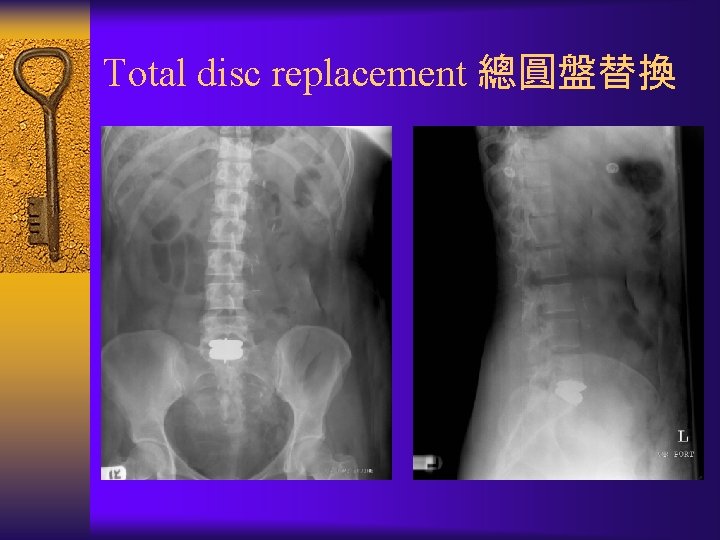 Total disc replacement 總圓盤替換 