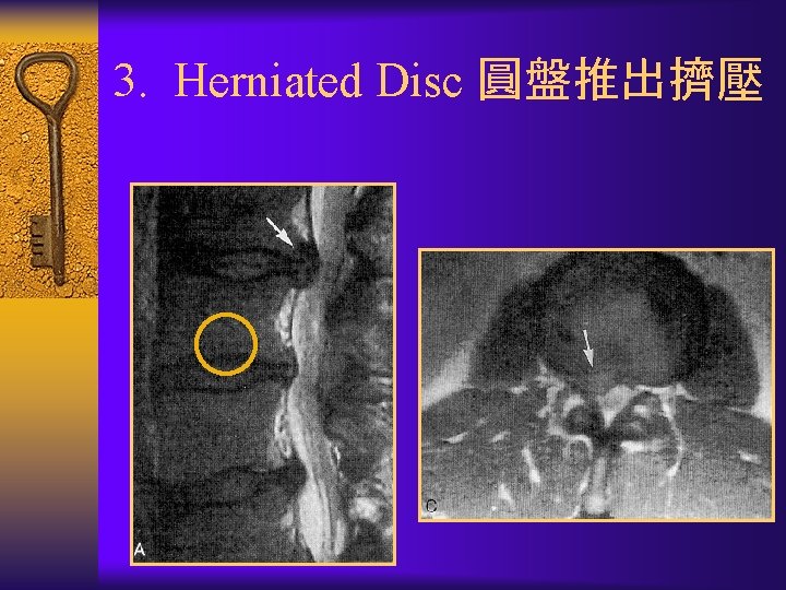 3. Herniated Disc 圓盤推出擠壓 