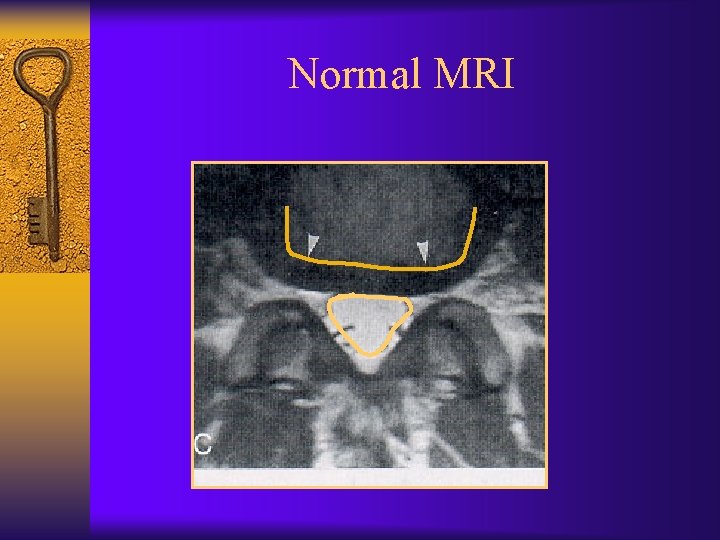 Normal MRI 