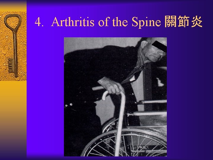 4. Arthritis of the Spine 關節炎 