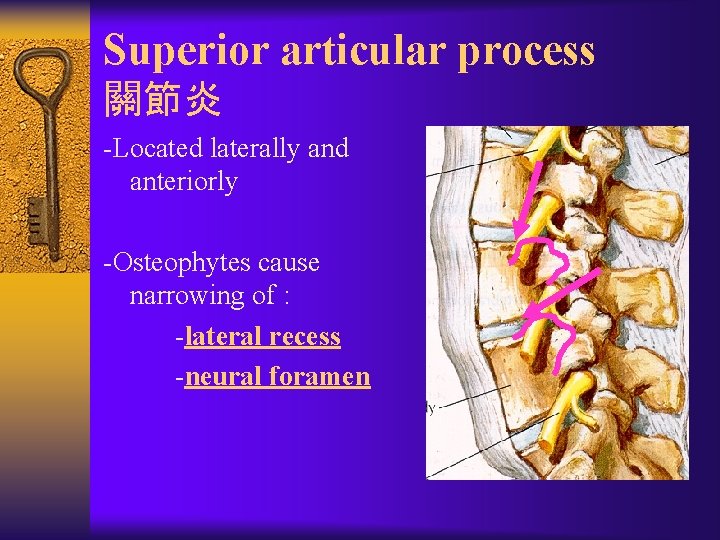 Superior articular process 關節炎 -Located laterally and anteriorly -Osteophytes cause narrowing of : -lateral