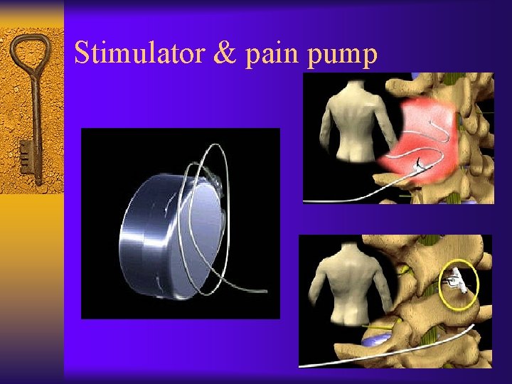 Stimulator & pain pump 