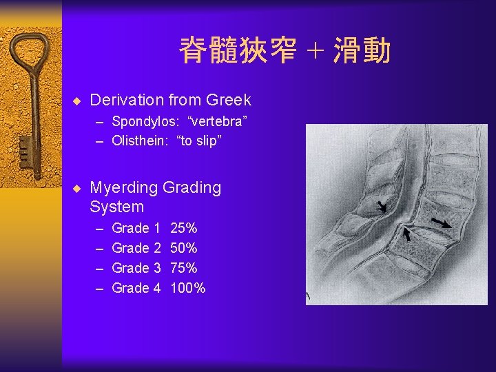  脊髓狹窄 + 滑動 ¨ Derivation from Greek – Spondylos: “vertebra” – Olisthein: “to
