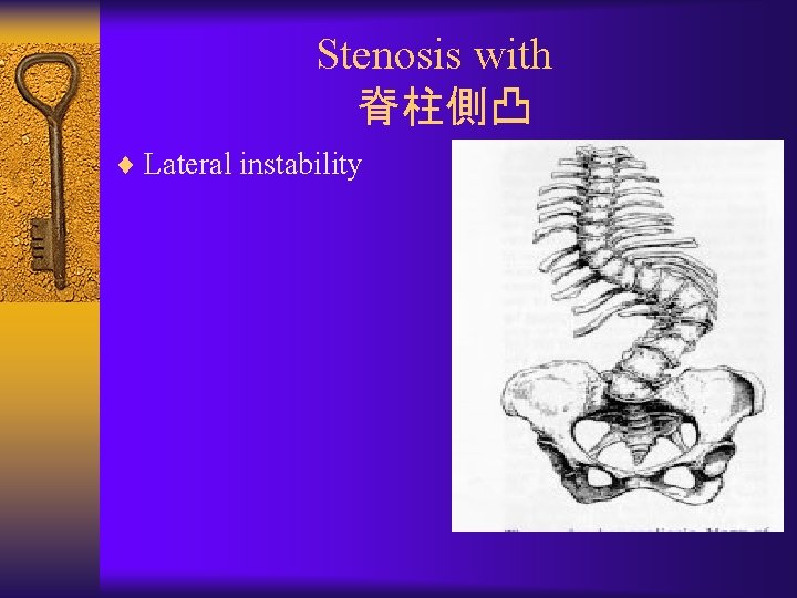 Stenosis with 脊柱側凸 ¨ Lateral instability 