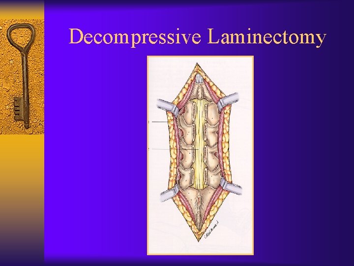 Decompressive Laminectomy 