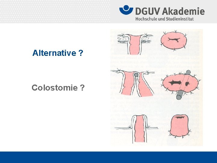 Alternative ? Colostomie ? 