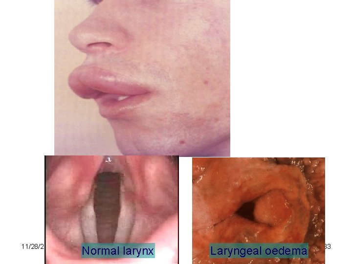 11/28/2020 Normal larynx Laryngeal oedema 33 