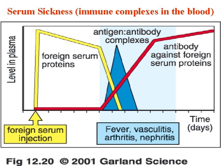 Serum Sickness (immune complexes in the blood). 11/28/2020 40 