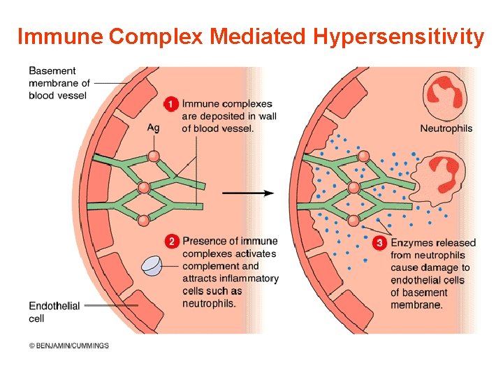 Immune Complex Mediated Hypersensitivity 11/28/2020 41 