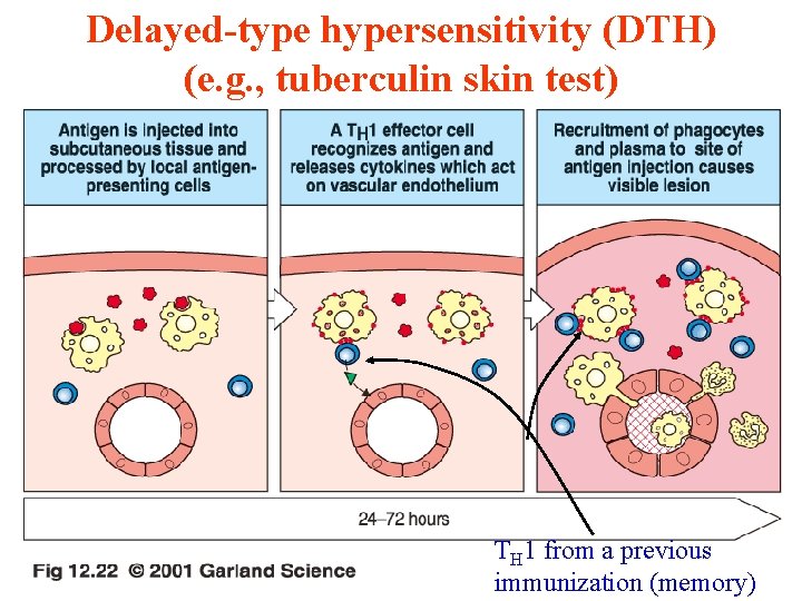 Delayed-type hypersensitivity (DTH) (e. g. , tuberculin skin test) 11/28/2020 TH 1 from a