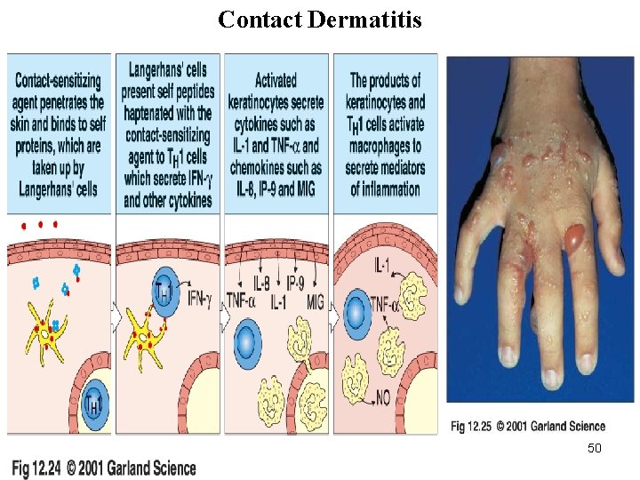 Contact Dermatitis 11/28/2020 50 