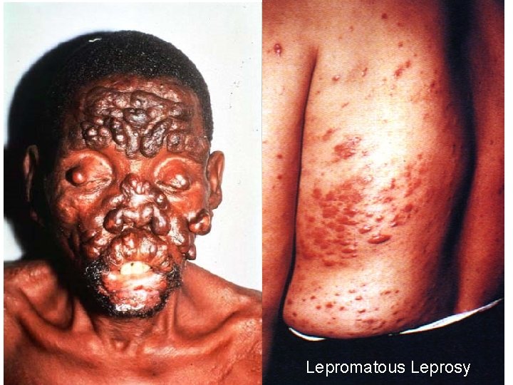 11/28/2020 Lepromatous Leprosy 55 