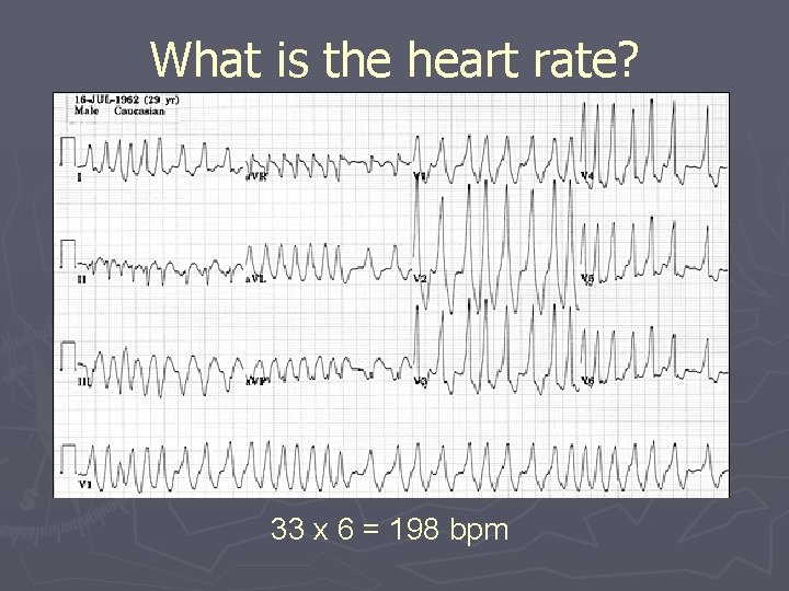 What is the heart rate? 33 x 6 = 198 bpm 