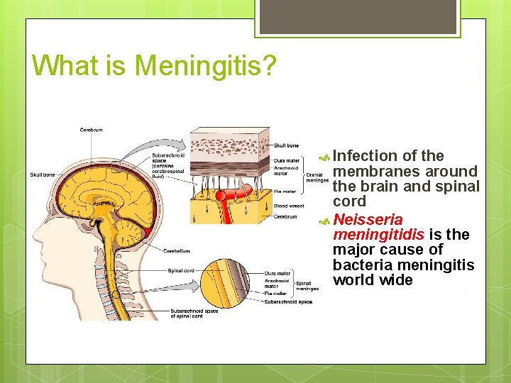 What is Meningitis? Infection of the membranes around the brain and spinal cord Neisseria