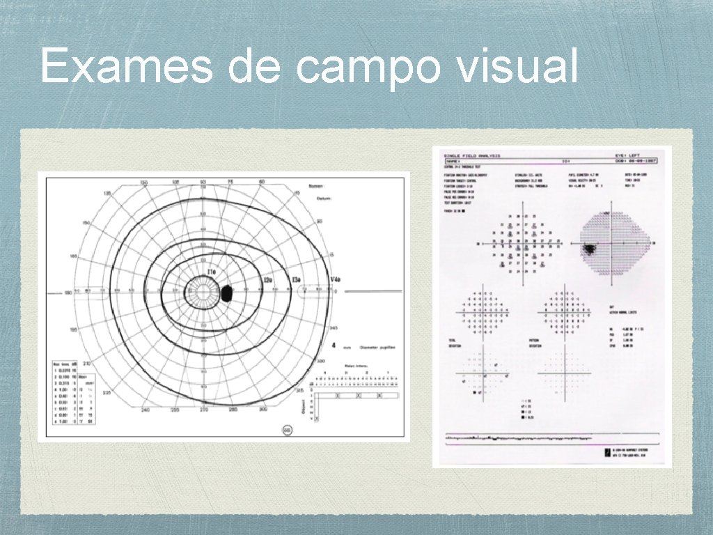 Exames de campo visual 