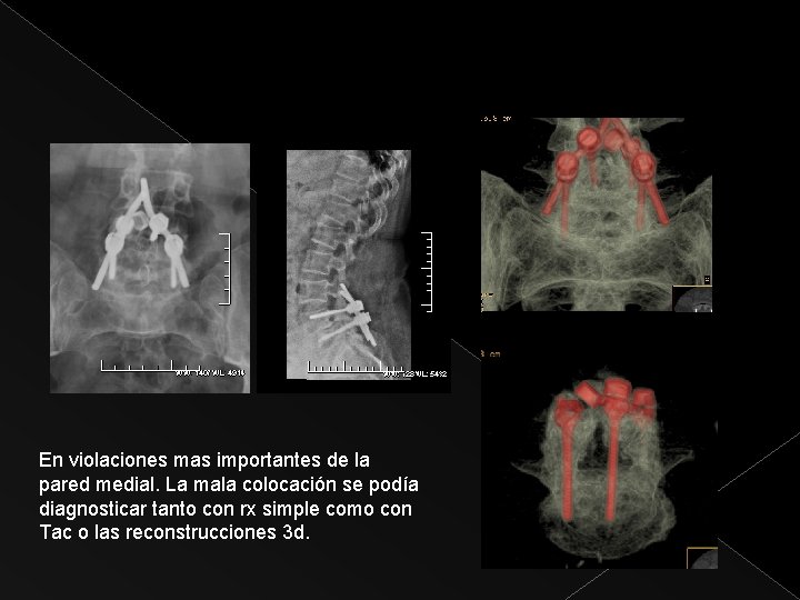 En violaciones mas importantes de la pared medial. La mala colocación se podía diagnosticar