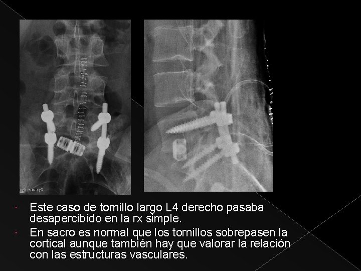  Este caso de tornillo largo L 4 derecho pasaba desapercibido en la rx