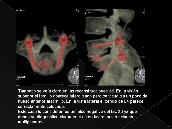 El orni Tampoco se veía claro en las reconstrucciones 3 d. En la visión