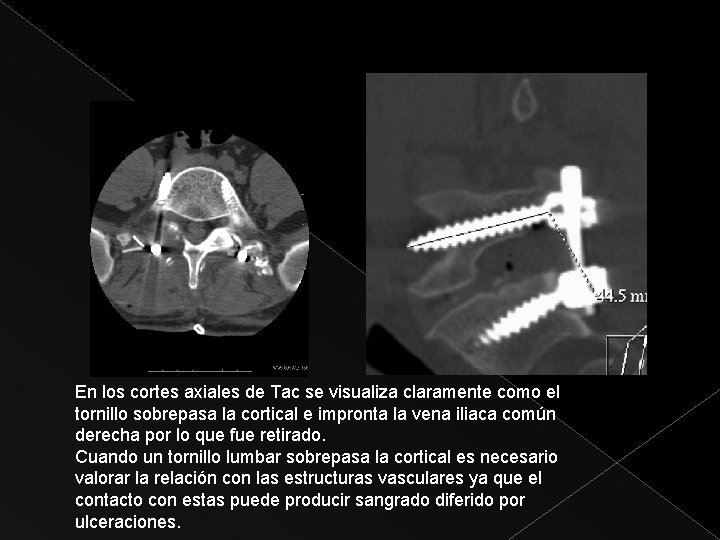 En los cortes axiales de Tac se visualiza claramente como el tornillo sobrepasa la