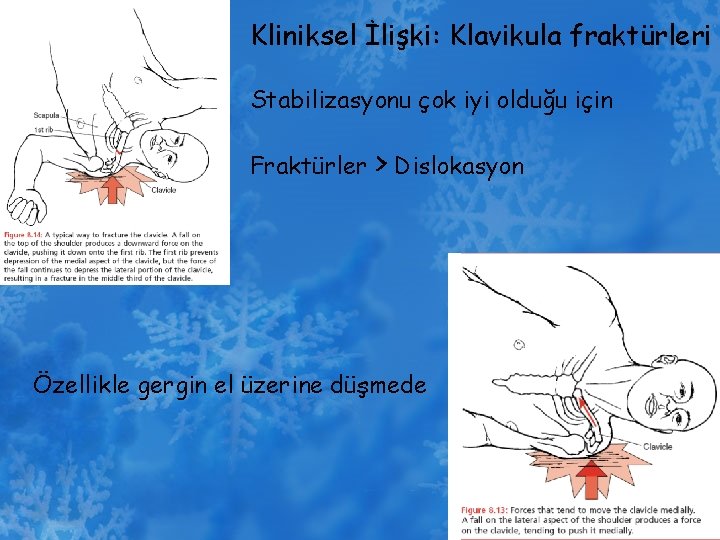 Kliniksel İlişki: Klavikula fraktürleri Stabilizasyonu çok iyi olduğu için Fraktürler > Dislokasyon Özellikle gergin